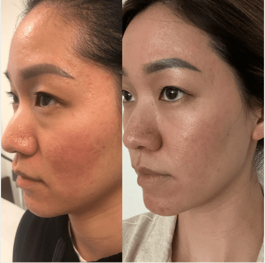 Facial Laser Treatment NYC | Best Laser Facial NYC | Laser Facial Near Me