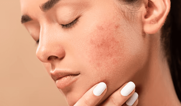 woman with acne removed